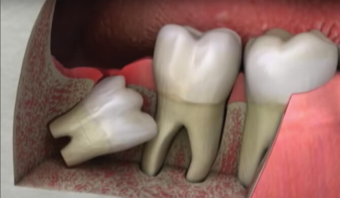 Protiniai dantys: palikti ar rauti?
