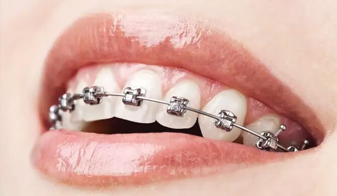Ką reikia žinoti norintiems tiesinti dantis breketais – kabėmis?